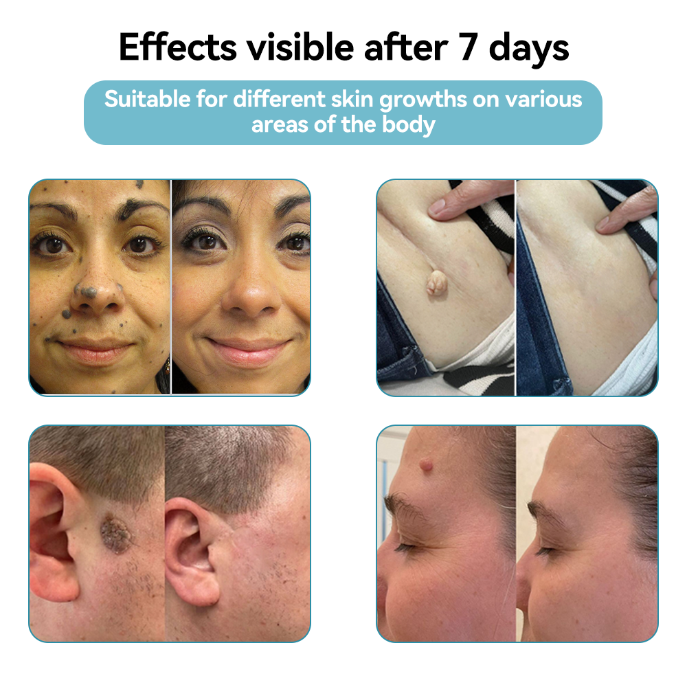 ๐๐๐ฌ๐ฌ๐๐๐ฆยฎ Medical-Grade Laser Pen ๐ (Powered by COโ laser technology โ effectively removes moles, warts, skin tags, pigmentation spots, and other skin imperfections)