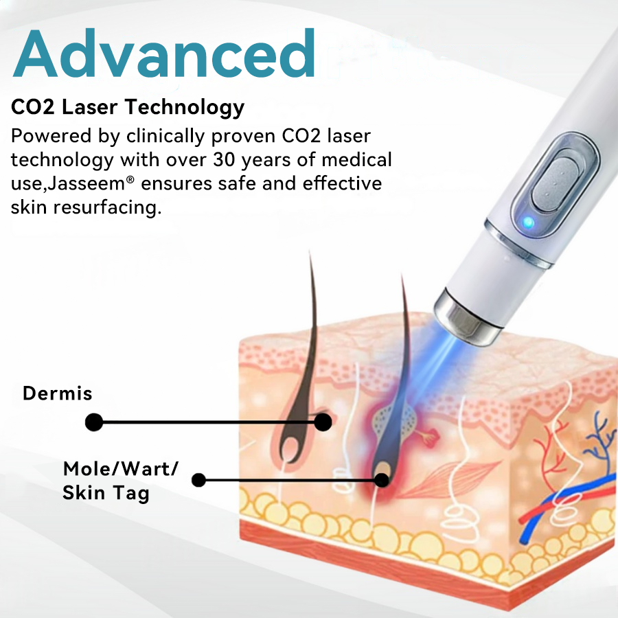 𝐉𝐚𝐬𝐬𝐞𝐞𝐦® Medical-Grade Laser Pen 🎉 (Powered by CO₂ laser technology – effectively removes moles, warts, skin tags, pigmentation spots, and other skin imperfections)